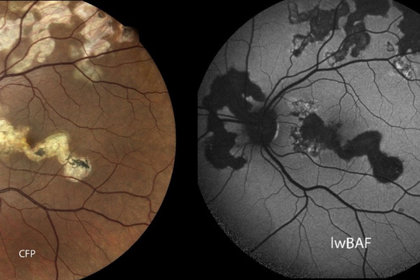 Bild vergrößern: Vereinfachte Diagnose von Augenkrankheit