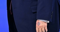 Davos: Deutlich sichtbarer Bluterguss an Trumps linker Hand