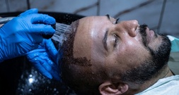 Zahl der Schönheits-OPs bei Männern fast verdoppelt