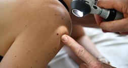 Krankenkasse: Deutlicher Anstieg bei Hautkrebspatienten