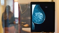 Mammografie: Altersgrenze für Brustkrebs-Früherkennung wird herabgesetzt